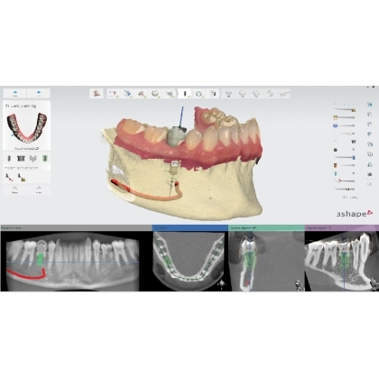  Софтуер за планиране на имплантологични случаи 3Shape Implant Studio 